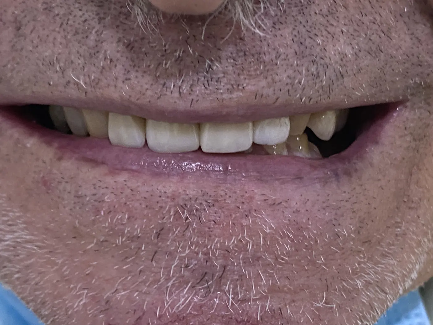 Depois: Caso 1