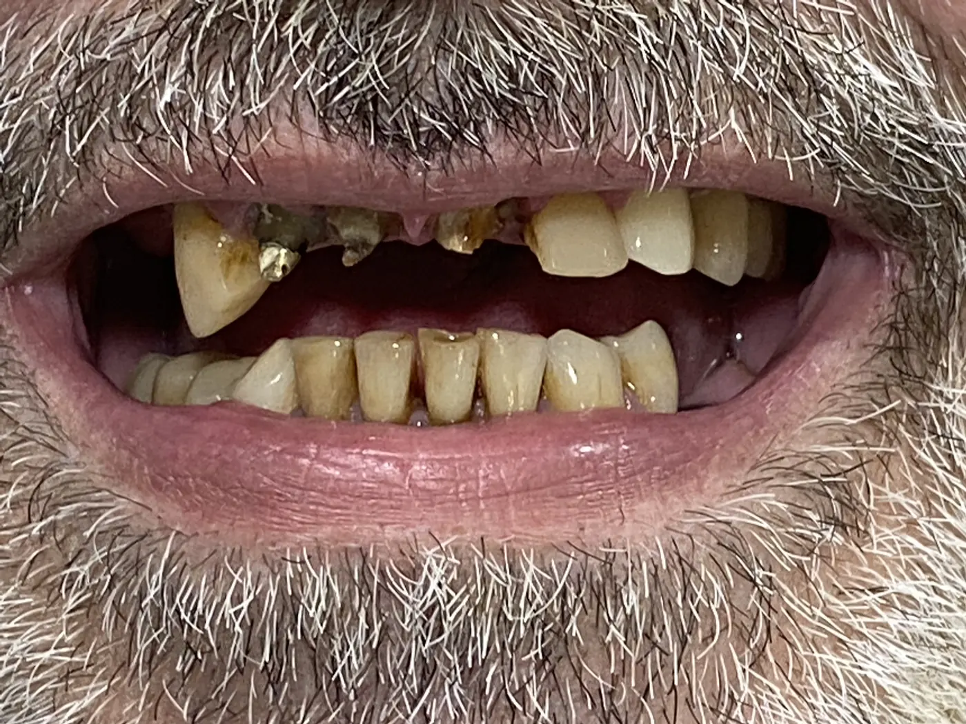 Antes: Caso 5