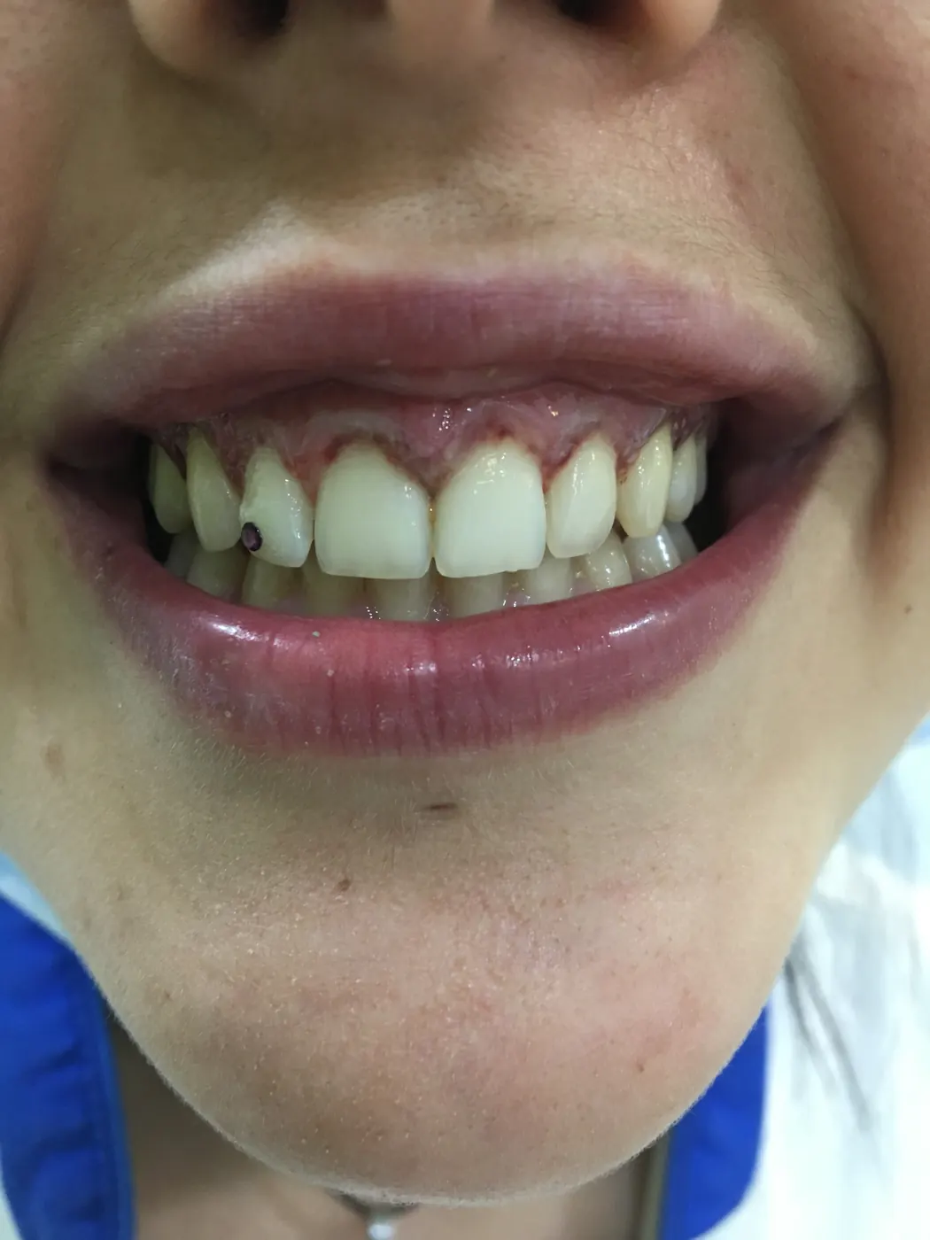 Antes: Caso 14