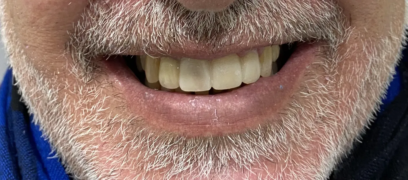 Depois: Caso 29