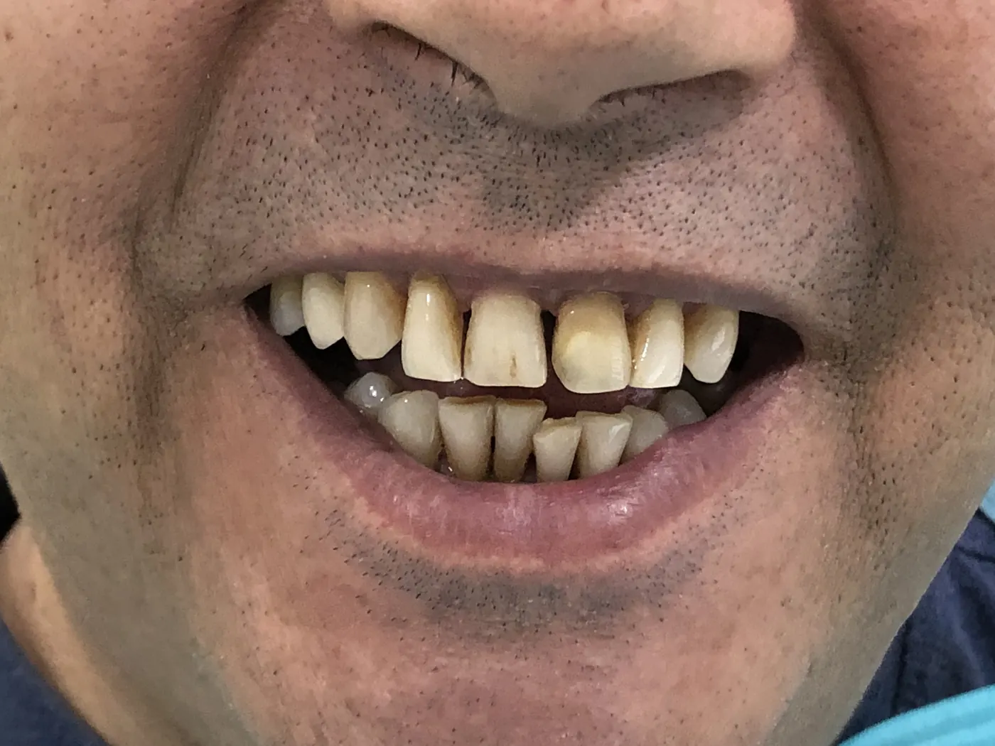 Antes: Caso 30