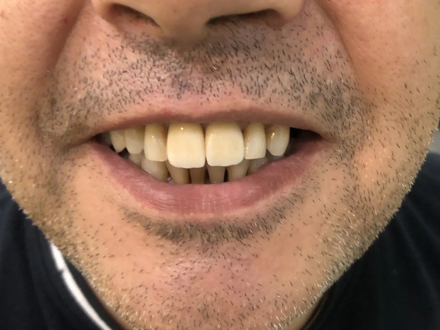 Depois: Caso 30